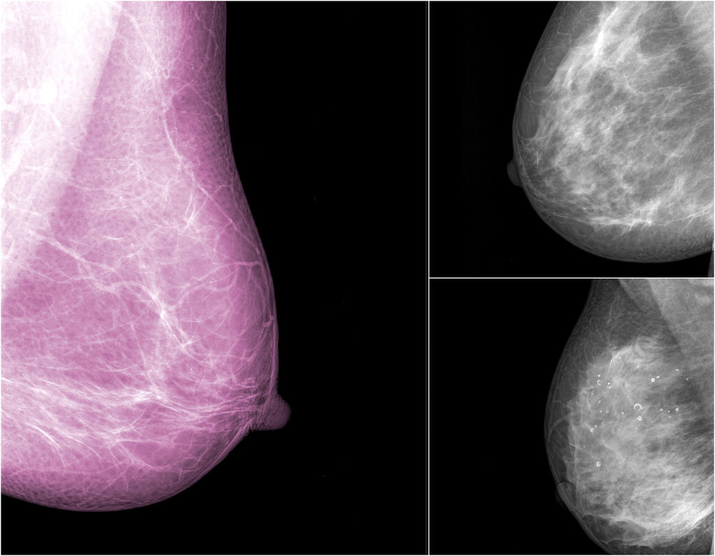 Cancer du sein :  LE CASSE TÊTE DE LA PRISE EN CHARGE