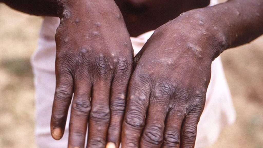 MPOX : Aucun cas enregistré au Mali