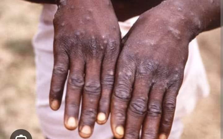 MPOX en Afrique : 1 100 décès enregistrés, depuis le début de l’année