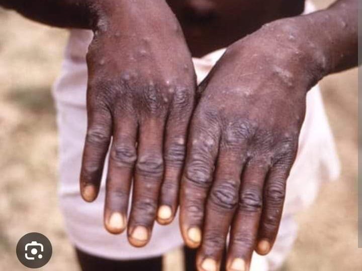 MPOX en Afrique : 1 100 décès enregistrés, depuis le début de l’année