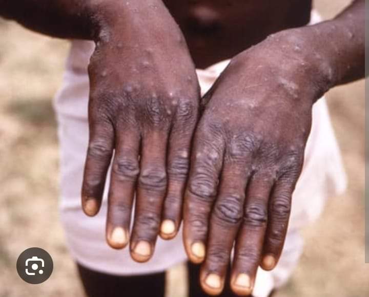 MPOX en Afrique : 1 100 décès enregistrés, depuis le début de l’année