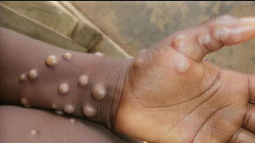 Recrudescence des cas de Mpox en Guinée: Le Mali renforce sa surveillance épidémiologique 