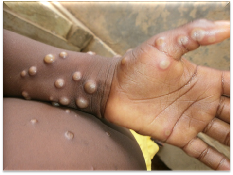 Mpox au Mali : Un premier cas confirmé à Kourémalé